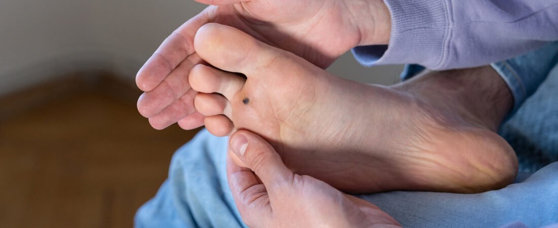 Corn vs Wart: What’s the Difference?