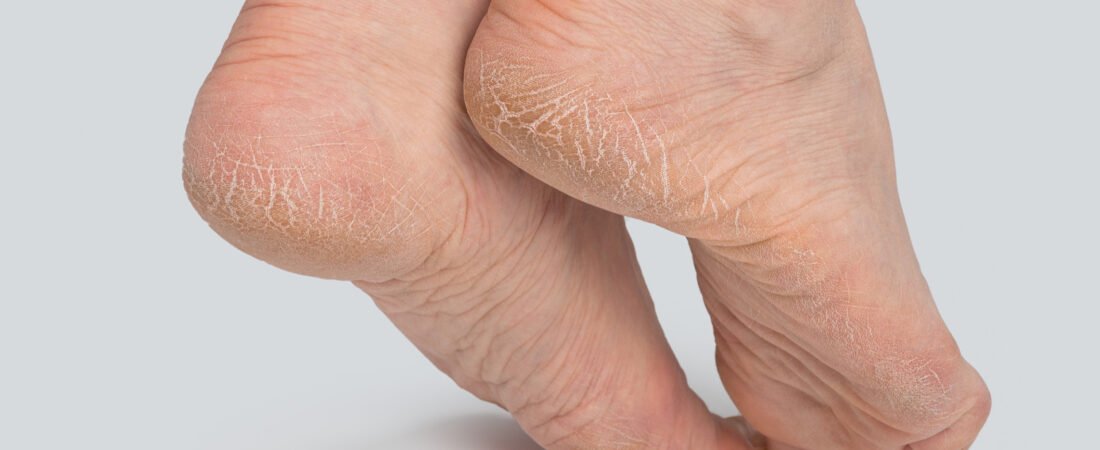 Cracked Heels(Dry, Split Heels)