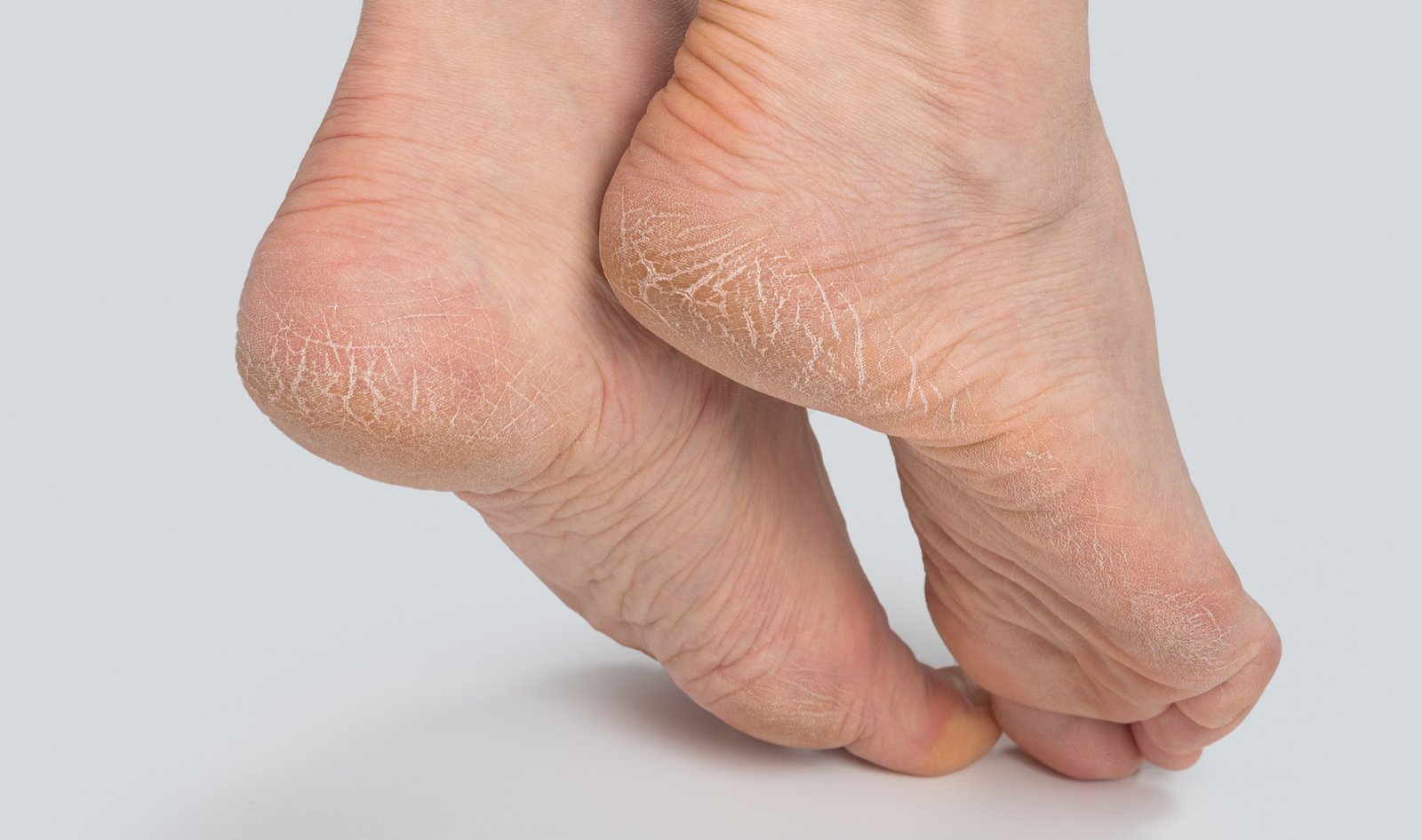 Cracked Heels(Dry, Split Heels)