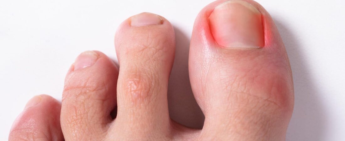Antibiotics Haven’t Fixed Your Ingrown Toenail?