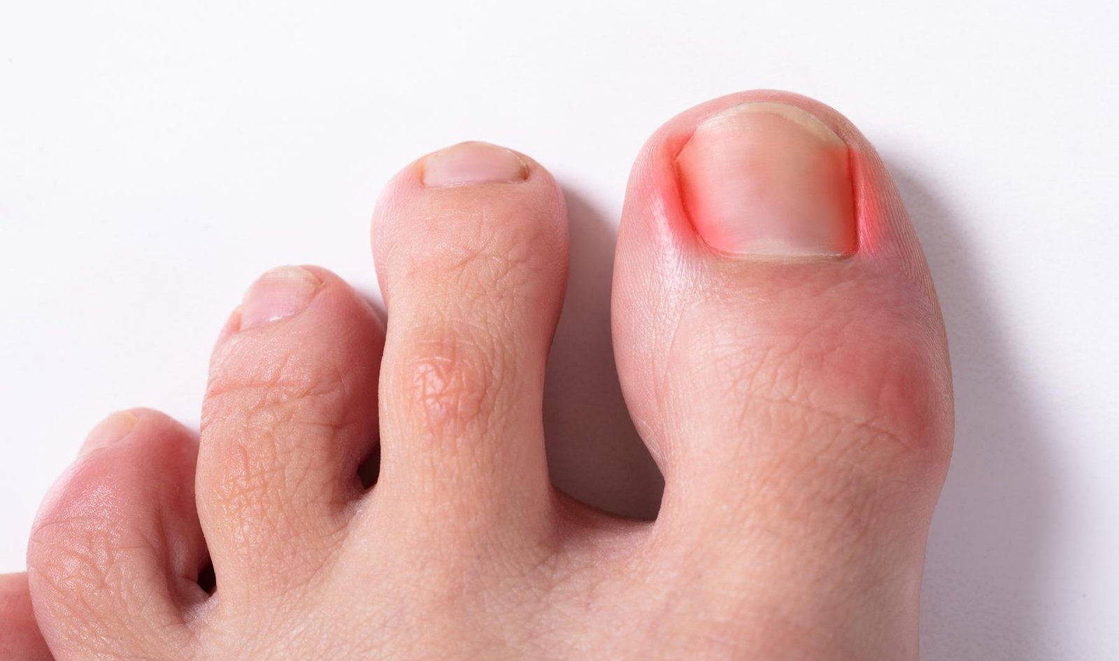 Antibiotics Haven’t Fixed Your Ingrown Toenail?